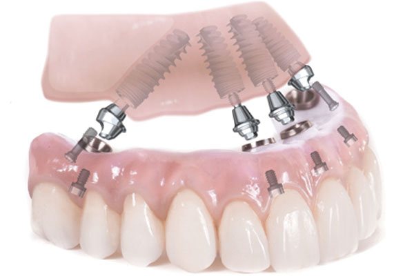 all on 4 dental implants - Orlando, FL