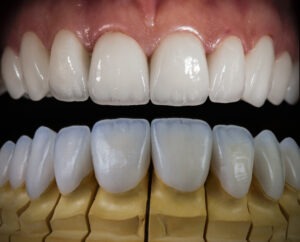 What Is the Difference Between Veneers and Dental Implants?