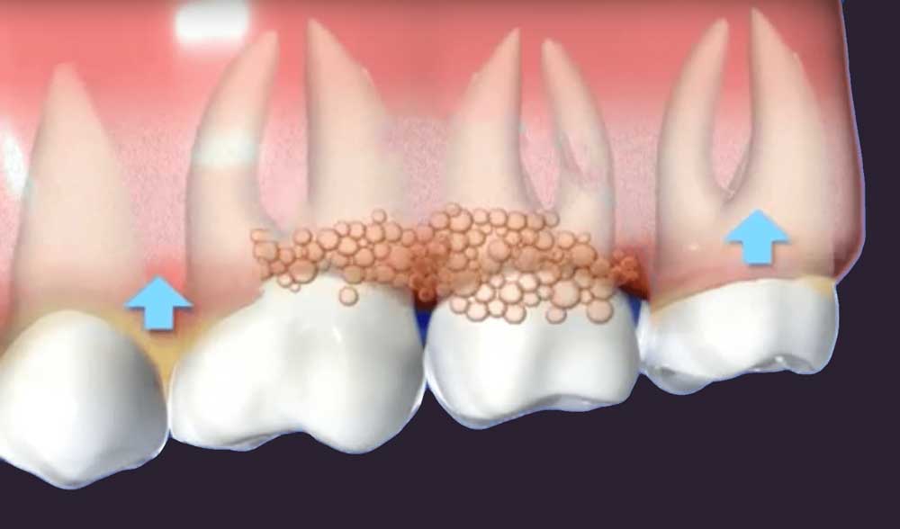 a diagram of gums affected by gum disease