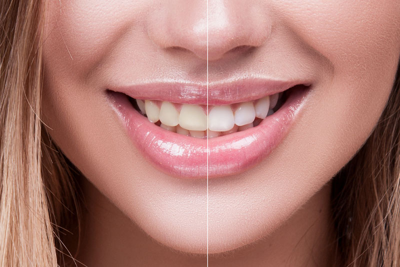 Tooth Whitening Patient Before and After Whitening