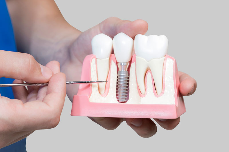 Bone Cutaway With A Dental Implant Screw Model